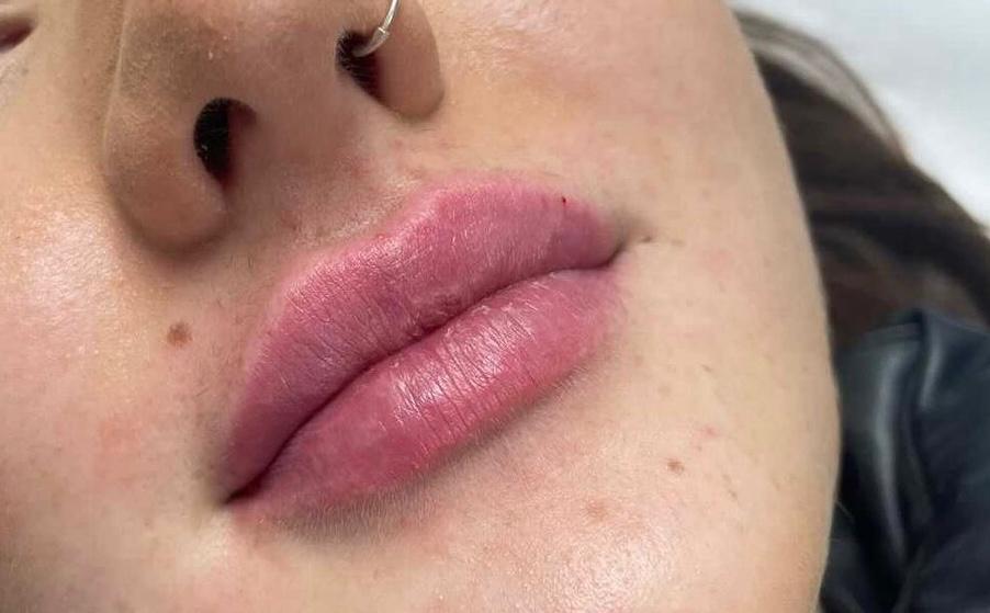 lip-filler-after