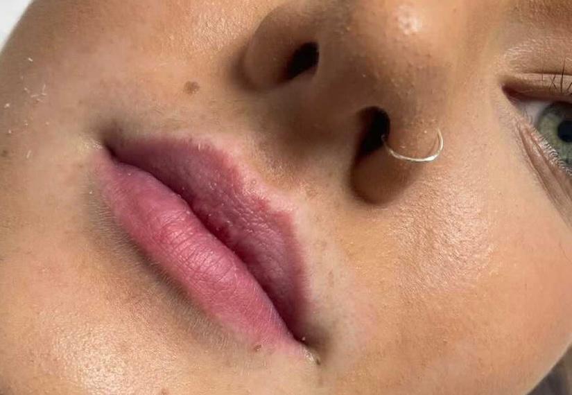 lip-filler-before