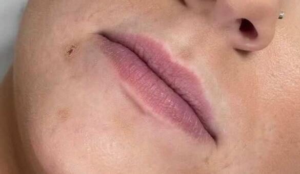 aesthetics-lip-filler