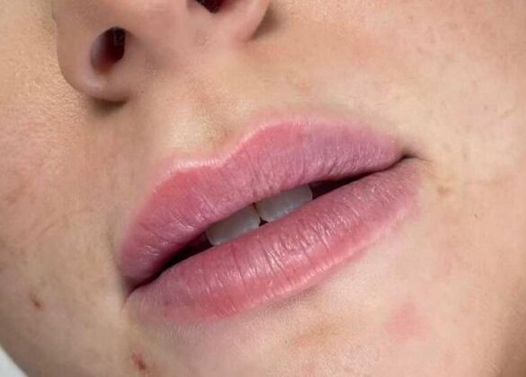aesthetics-lip-filler