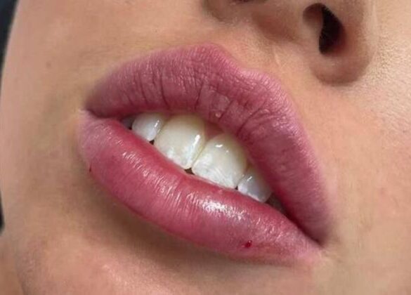 aesthetics-lip-filler