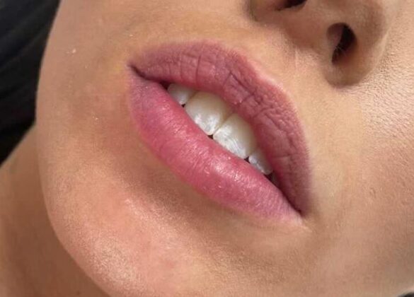 aesthetics-lip-filler