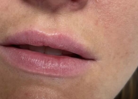 aesthetics-lip-filler