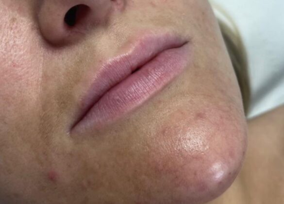 aesthetics-lip-filler