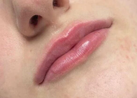 aesthetics-lip-filler