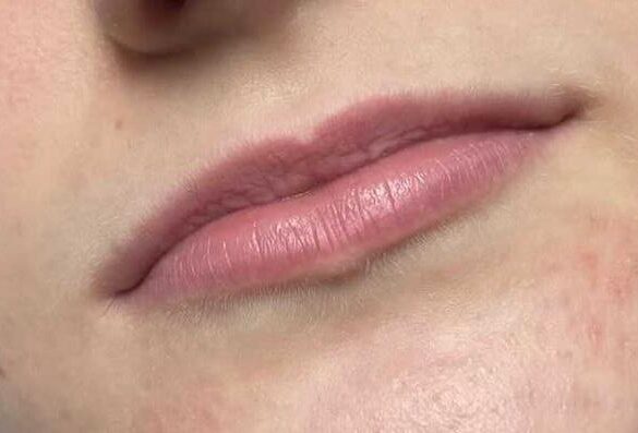 aesthetics-lip-filler