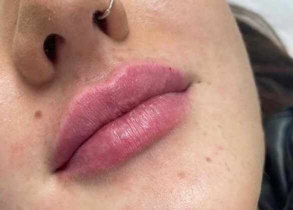 aesthetics-lip-filler