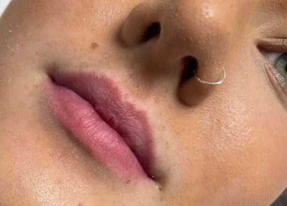 aesthetics-lip-filler