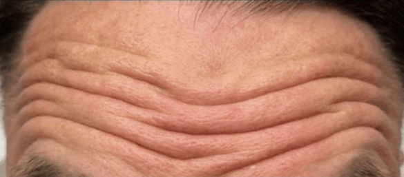 anti-wrinkles