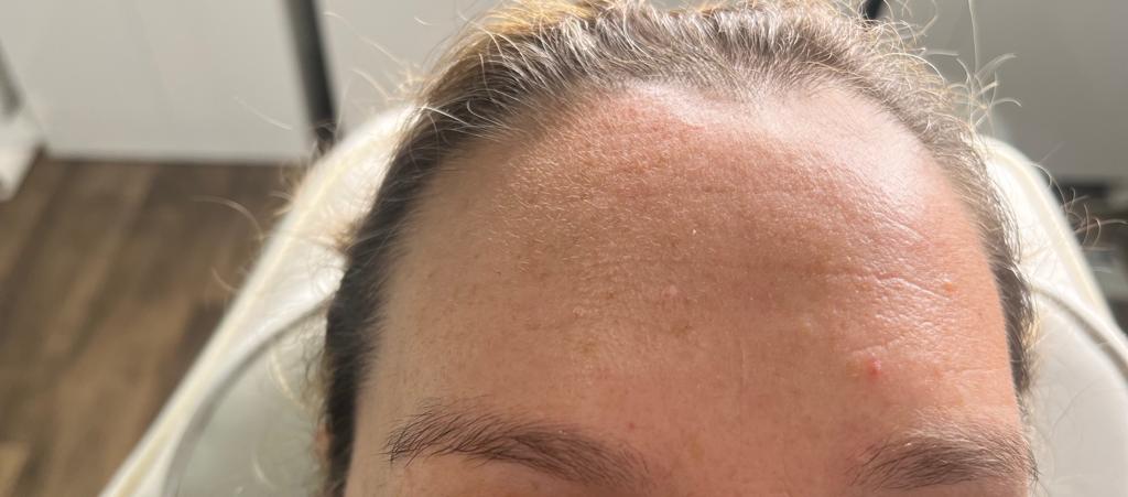 Anti-Wrinkle Injections