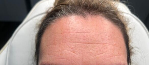 Anti-Wrinkle Injections