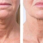 profhilo treatment
